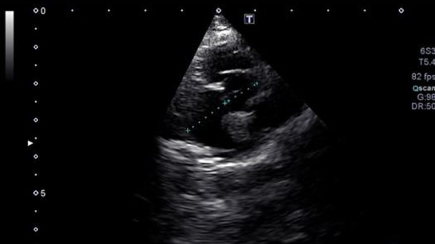 876x493 encina echocardiography